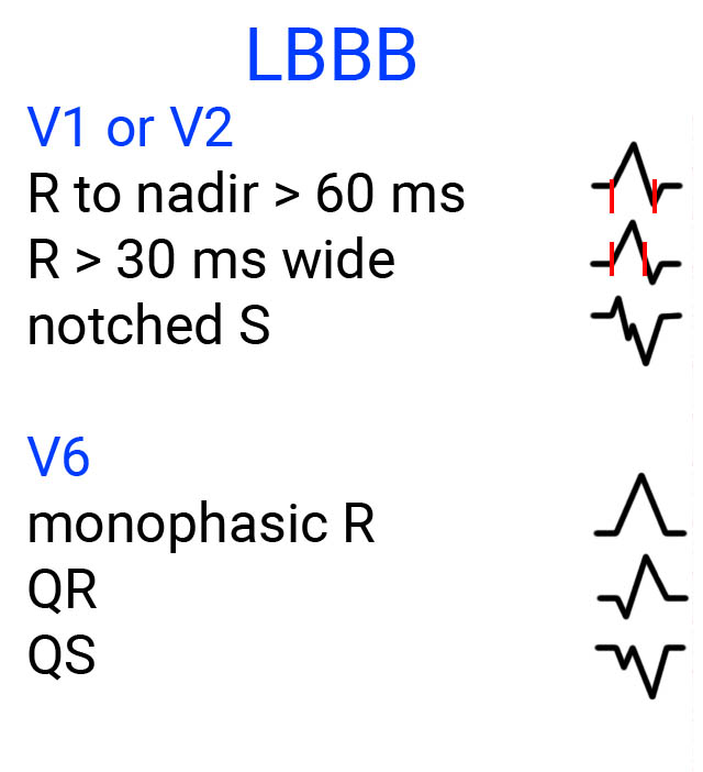 Brugada LBBB morphology criteria