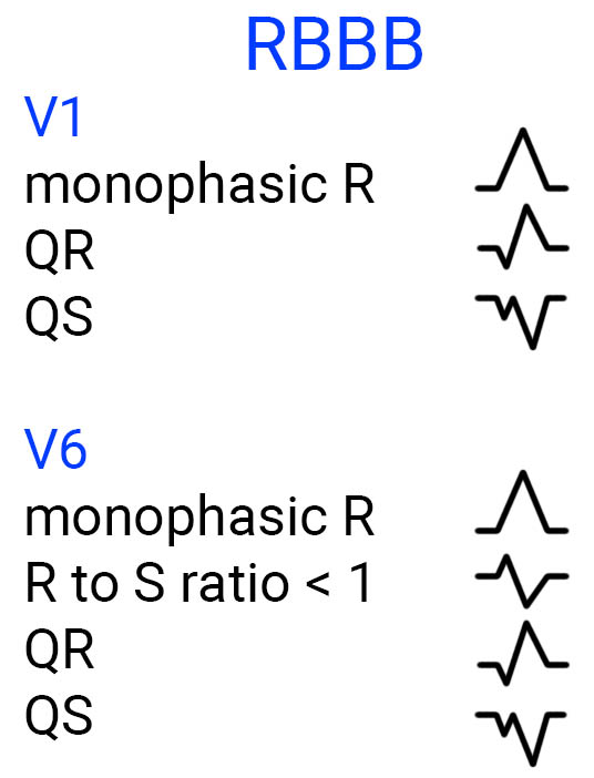 Brugada RBBB morphology criteria