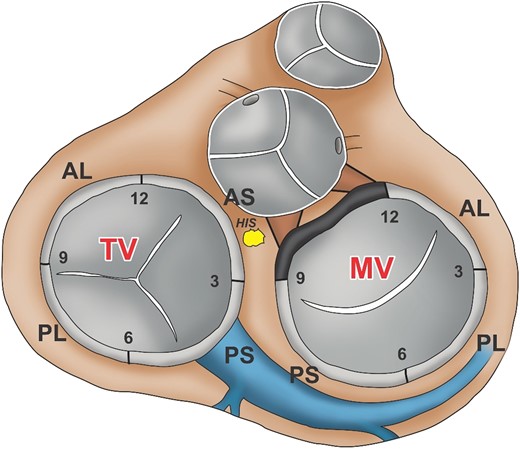 EASY WPW localization diagram